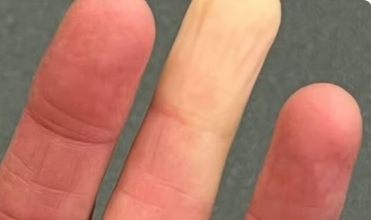 Elleriniz ve Ayaklarınız Renk Değiştiriyorsa Sadece Üşüme Değil! 